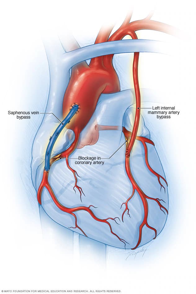 Heart Bypass Surgery
