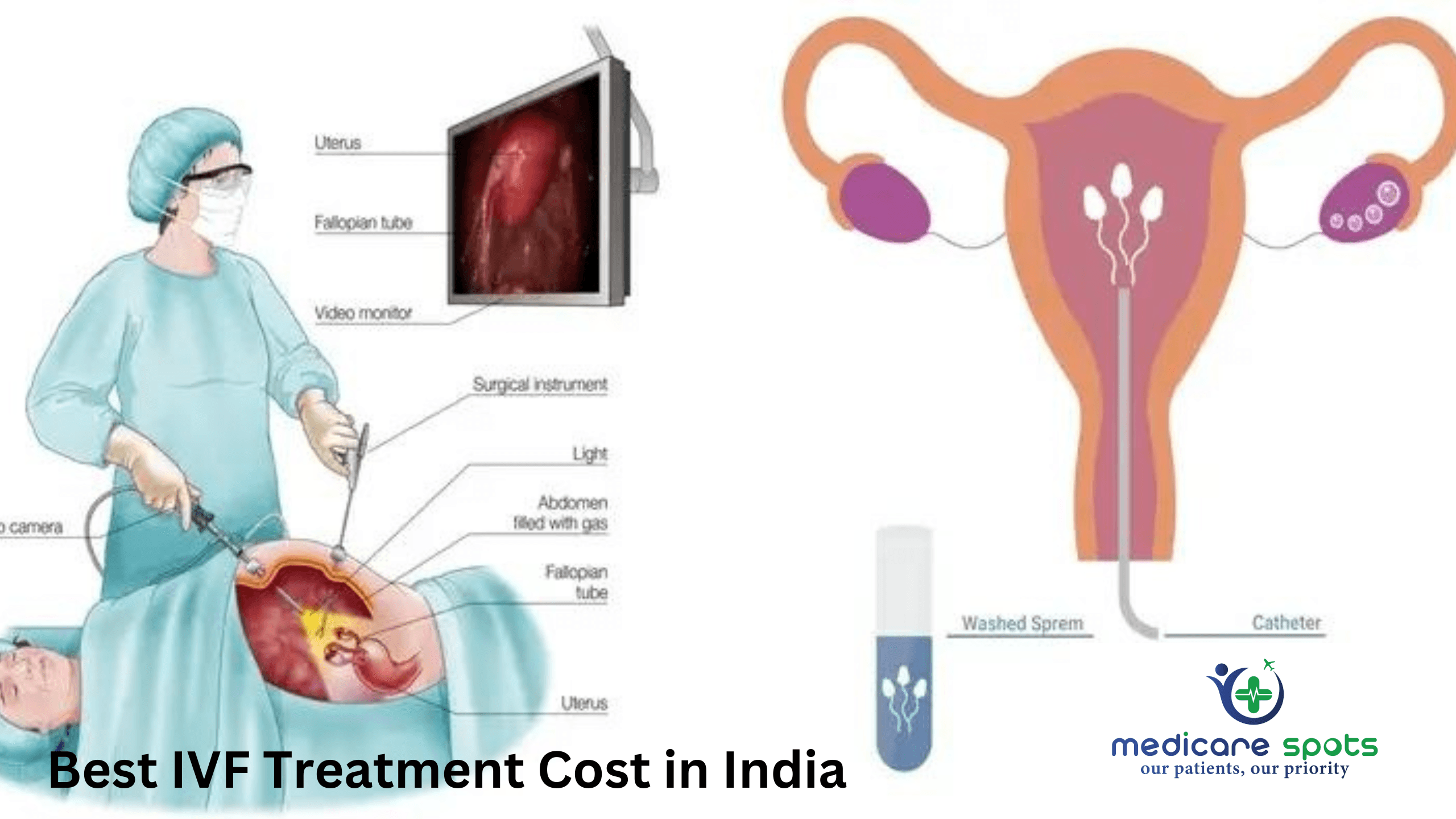 IVF Treatment