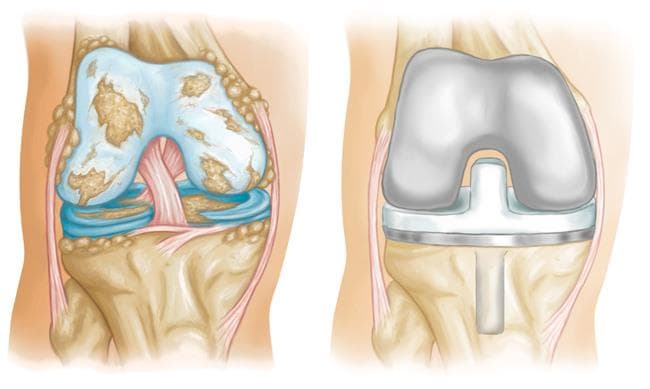 Knee Replacement