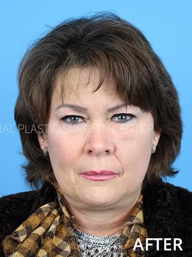Isabella Martinez after treatment